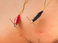 electrical-acupuncture