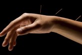 photolibrary_rf_photo_of_acupuncture_in_arm